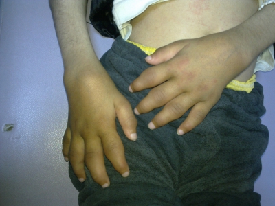 Tipik poliartiküler juvenil idyopatik artrit (JIA) (Suriyeli tedavi alamamış bir çocuk)