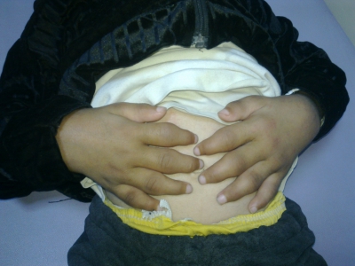 Suriye iç savaşından dolayı tanı ve tedavisi yapılamadığı için tipik poliartiküler juvenil idyopatik artrit (JIA) gösteren çocuk
