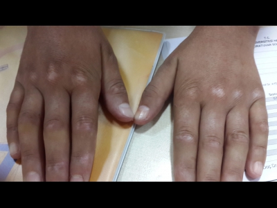 Juvenil Dermatomiyozitli çocukta ellerde Gottron papülleri
