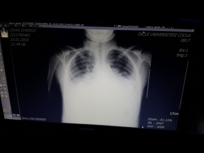Gomerülonefritli çocukta tanı gecikmesi nedeniyle oluşan akciğer ödeminin radyolojik görünümü