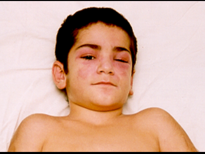 Juvenil Dermatomiyozit- Heliotrope Rash