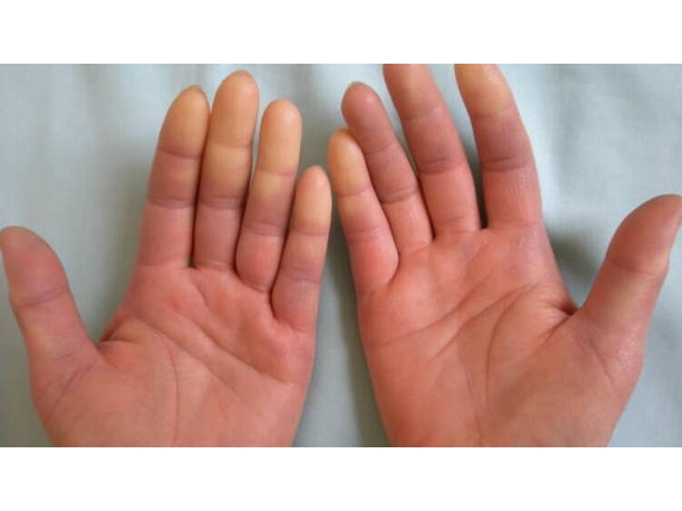 Raynaud Fenomeni ve Raynaud Sendromu